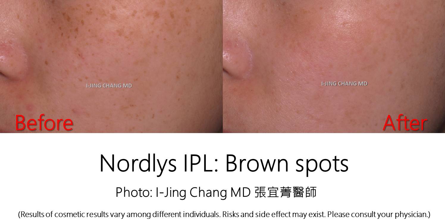 Nordlys IPL before and after