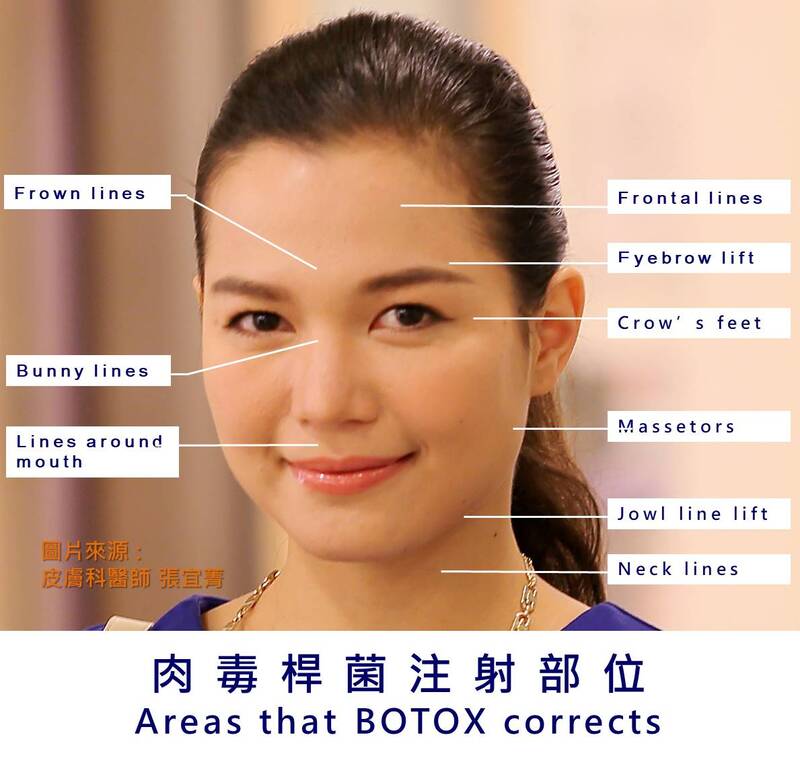 BOTOX treatment areas