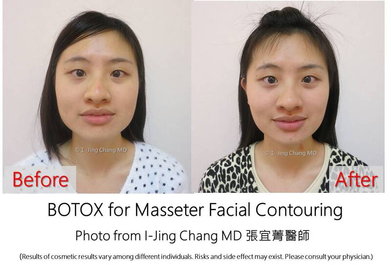 injection before and after