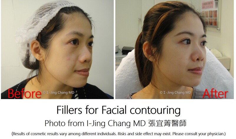 injection before and after