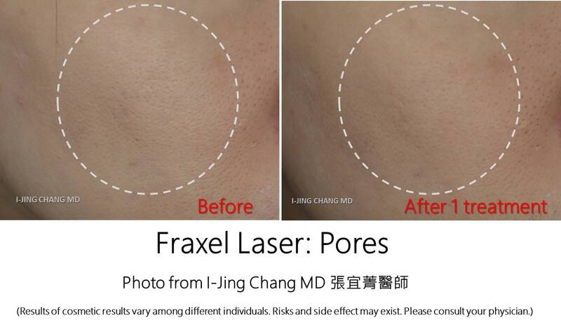 Fraxel for pores