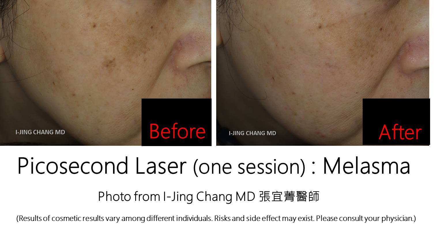 Picosecond laser before and after