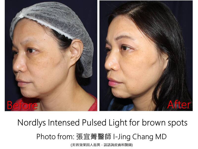 IPL brown spots