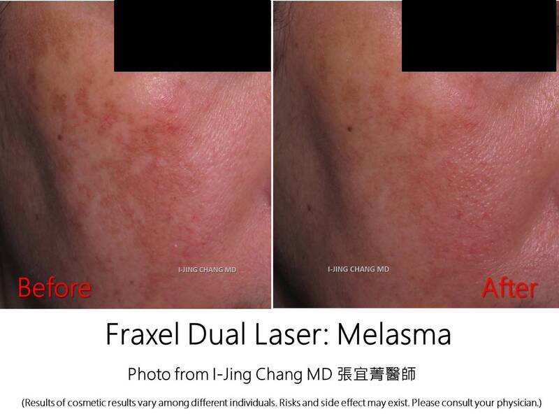Fraxel before and after