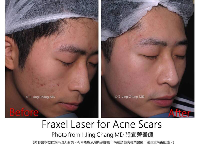 laser before and after