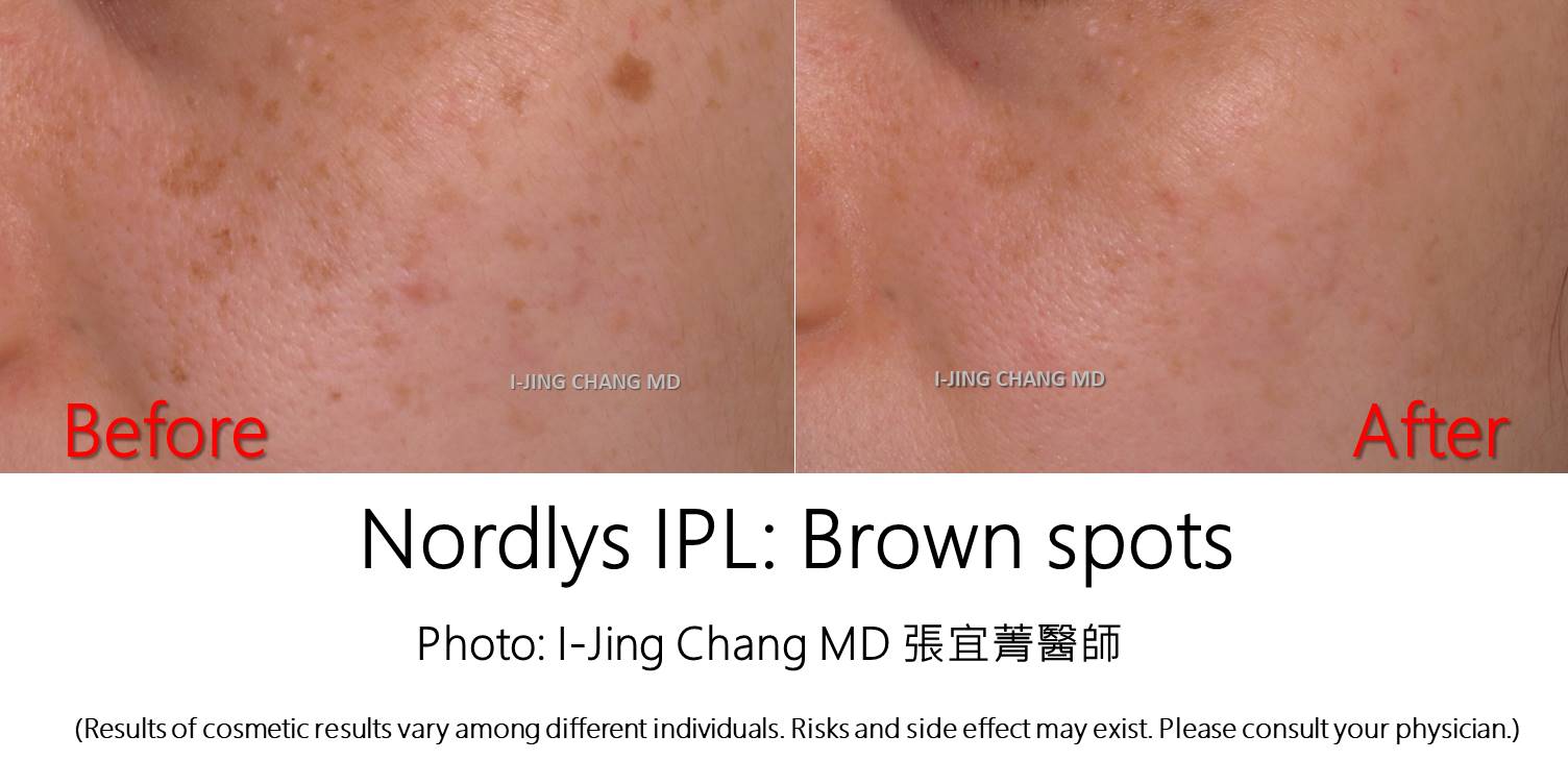 Nordlys IPL before and after