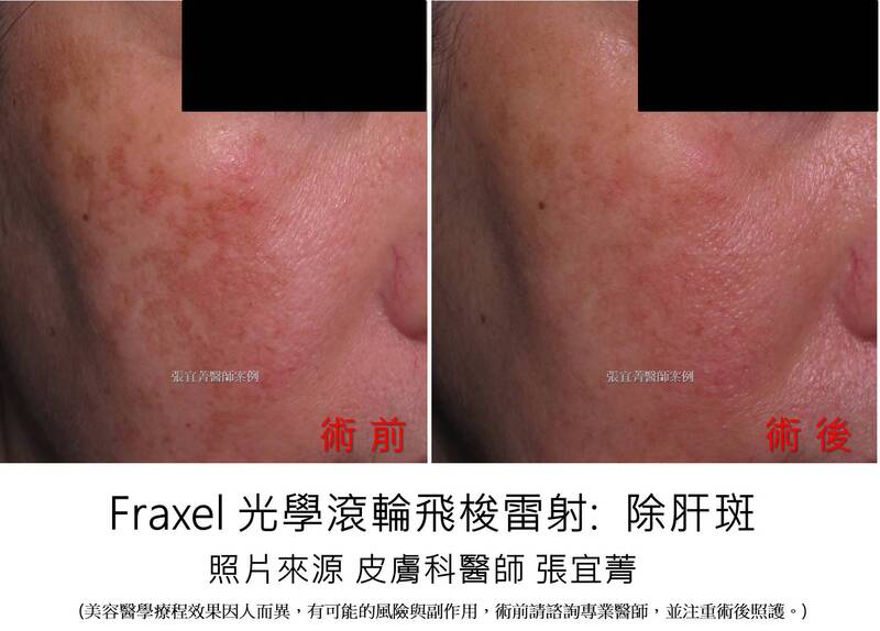 Fraxel 飛梭雷射